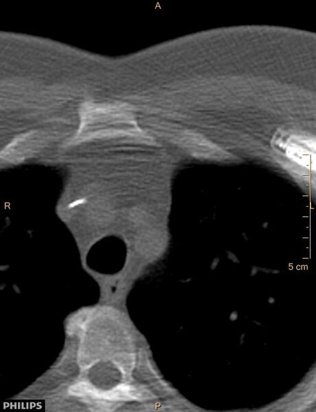 File:Calcified cardiac fibroma (Radiopaedia 39267-41519 Axial bone window 1).jpg
