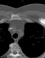 Calcified cardiac fibroma (Radiopaedia 39267-41519 Axial bone window 1).jpg