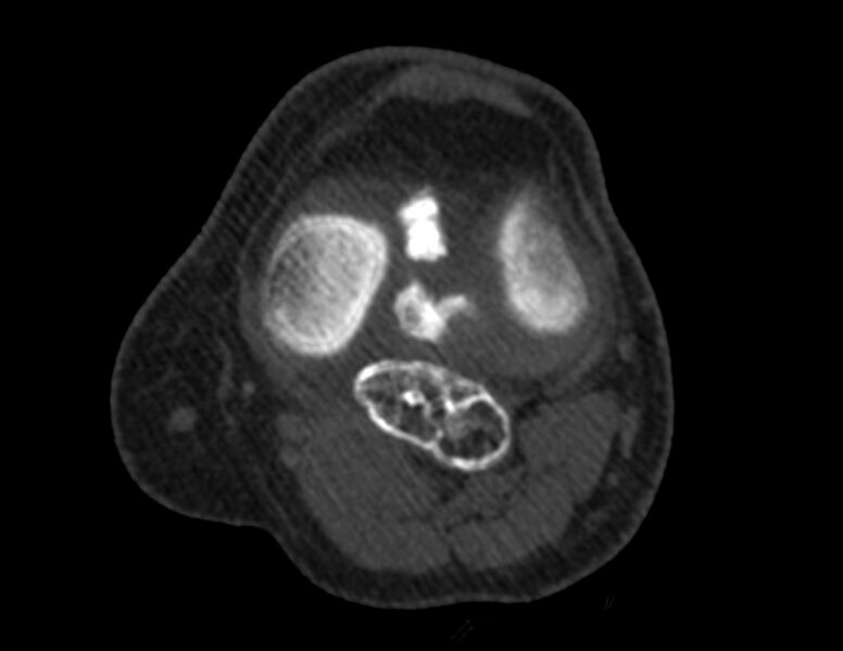 File:Calcified hematoma - popliteal fossa (Radiopaedia 63938-72763 Axial bone window 21).jpg