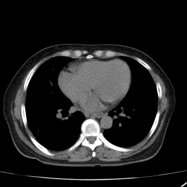 File:Calcified hepatic hydatid cyst (Radiopaedia 26872-27046 Axial non-contrast 5).jpg