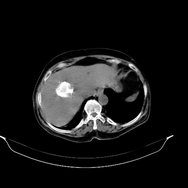 File:Calcified hydatid cyst (Radiopaedia 62000-70085 Axial non-contrast 25).jpg