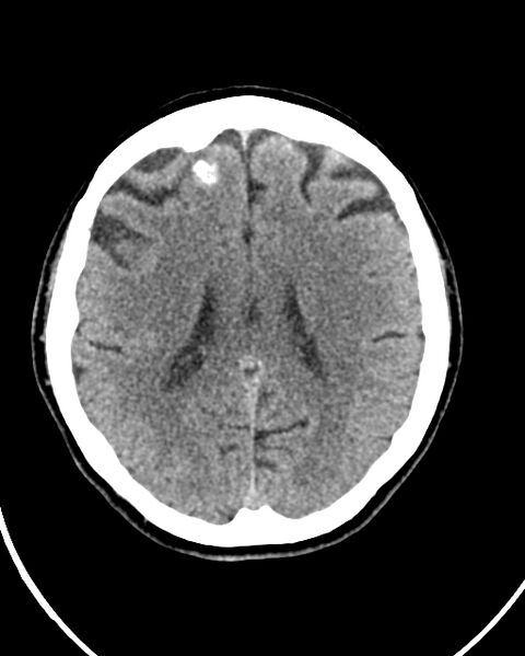 File:Calcified meningioma (Radiopaedia 74361-85243 Axial non-contrast 20).jpg