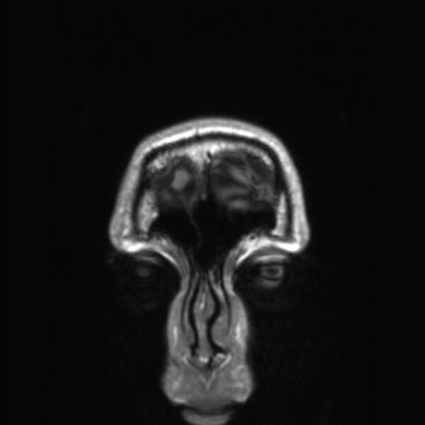 File:Callosal dysgenesis with interhemispheric cyst (Radiopaedia 53355-59335 Coronal T1 184).jpg