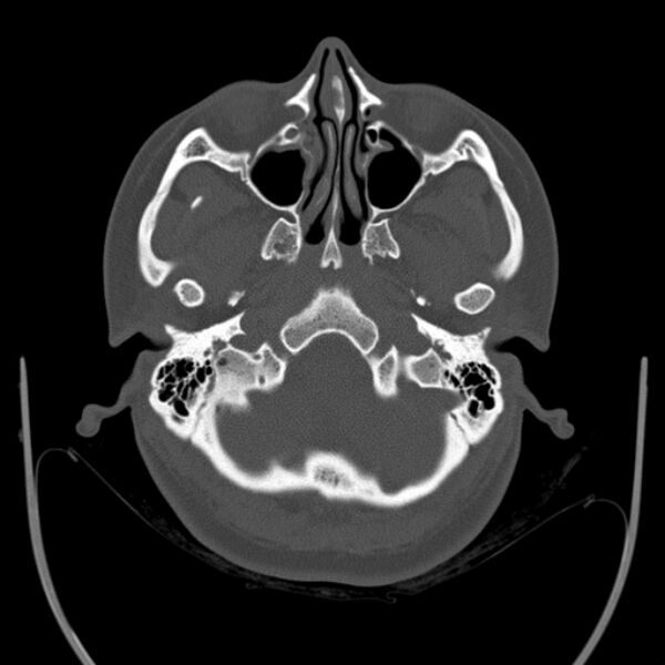 File:Calvarial osteoma (Radiopaedia 36520-38079 Axial bone window 17).jpg