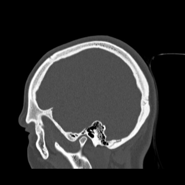 File:Calvarial osteoma (Radiopaedia 36520-38079 Sagittal bone window 25).jpg