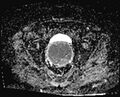 Cancer cervix - stage IIb (Radiopaedia 75411-86615 Axial ADC 14).jpg
