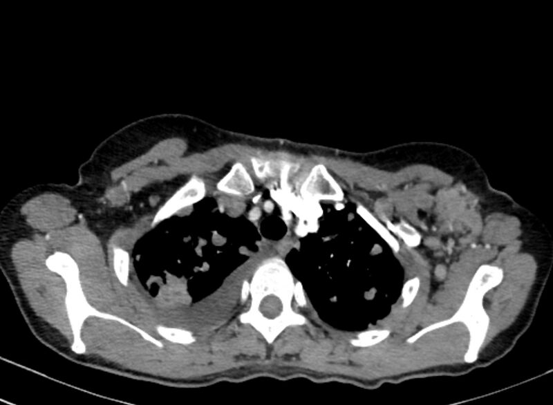 File:Cannonball metastases from breast cancer (Radiopaedia 91024-108569 A 26).jpg