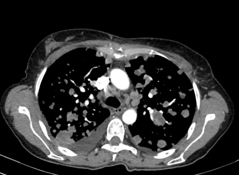 File:Cannonball metastases from breast cancer (Radiopaedia 91024-108569 A 43).jpg
