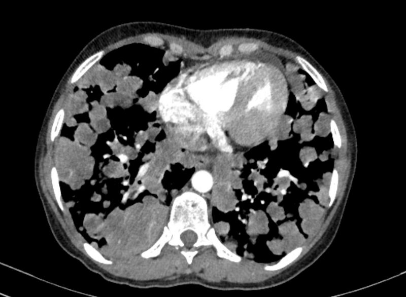 File:Cannonball metastases from breast cancer (Radiopaedia 91024-108569 A 87).jpg