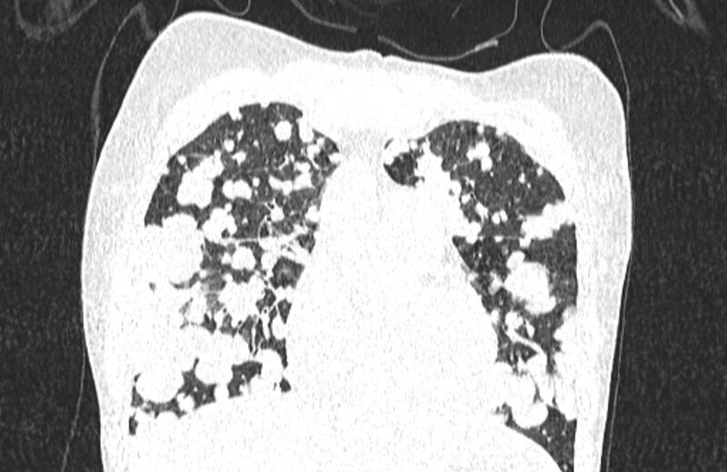 File:Cannonball metastases from breast cancer (Radiopaedia 91024-108569 Coronal lung window 47).jpg