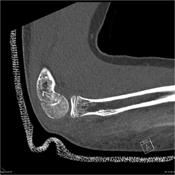 File:Capitellum fracture (Radiopaedia 23352-23426 Sagittal bone window 14).jpg