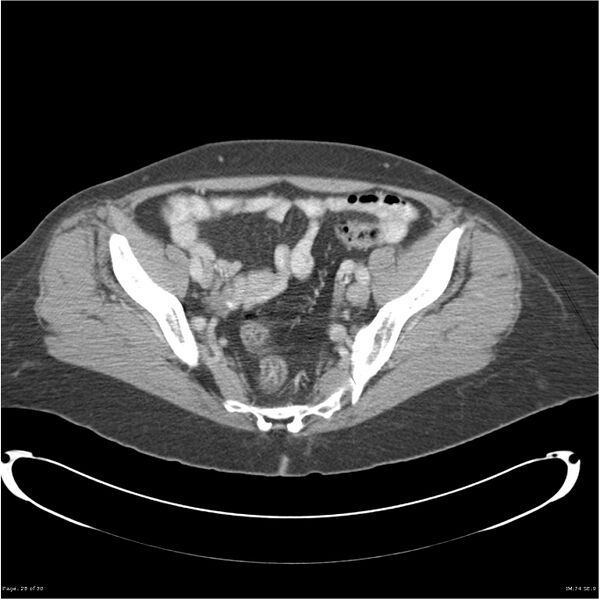 File:Carcinoid tumor of the ileum with metastasis to orbit (Radiopaedia 28165-28425 A 28).jpg
