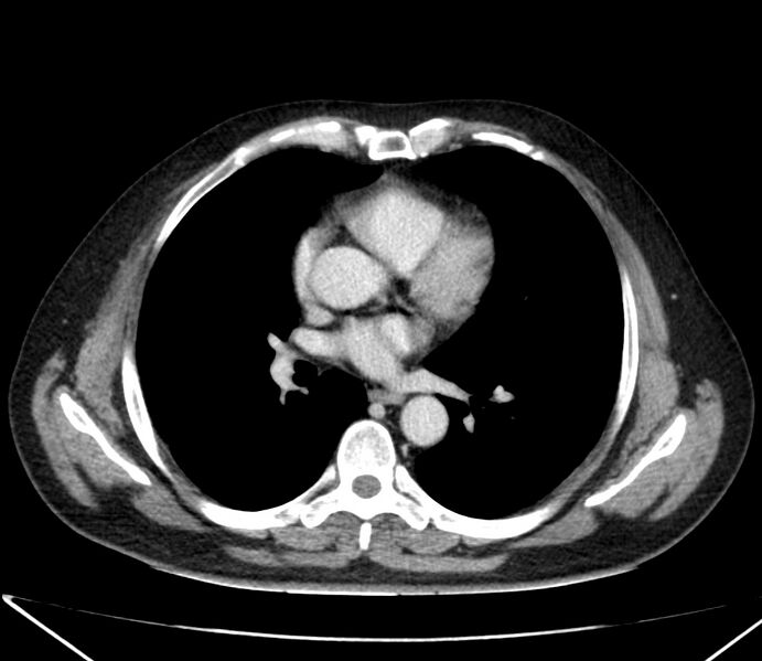 File:Carcinoid tumor with hepatic metastases (Radiopaedia 22651-22670 C 18).jpg