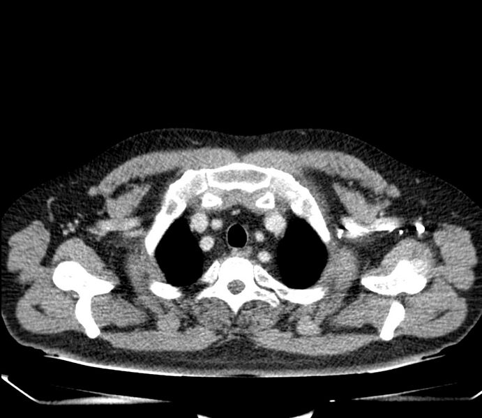 File:Carcinoid tumor with hepatic metastases (Radiopaedia 22651-22670 C 4).jpg
