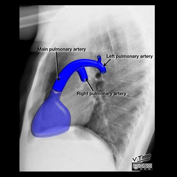 File:Cardiomediastinal anatomy on chest radiography (annotated images) (Radiopaedia 46331-50772 Q 4).jpeg