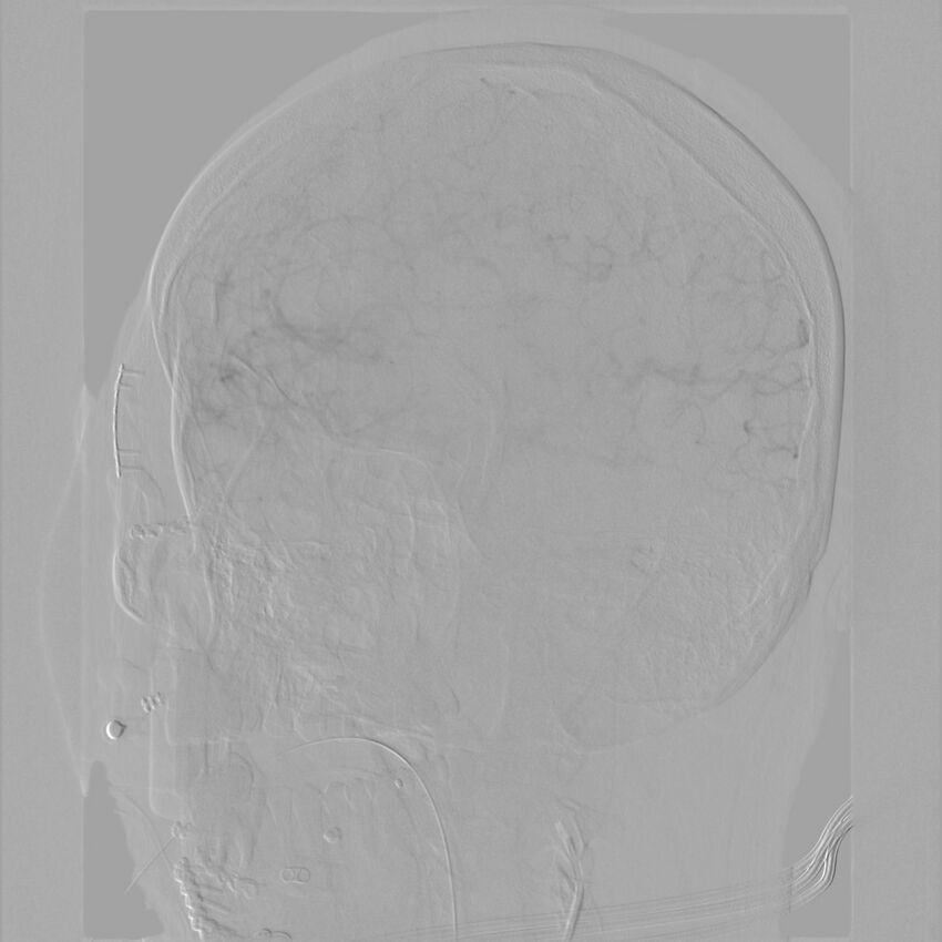 Caroticocavernous fistula - direct (Radiopaedia 61660-69666 Oblique Left ICA 32).jpg