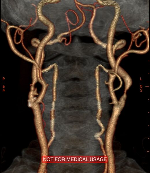 File:Carotid artery stenosis (Radiopaedia 28786-29086 A 1).jpg