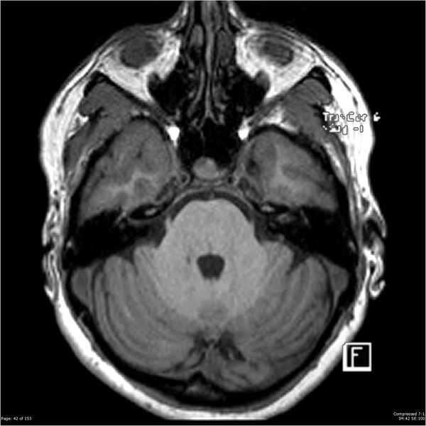 File:Cavernous malformation (cavernous angioma or cavernoma) (Radiopaedia 36675-38237 Axial T1 31).jpg