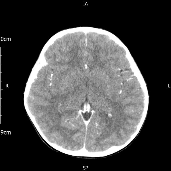 File:Cavernous sinus thrombosis (Radiopaedia 79414-92510 Axial Brain 103).jpg
