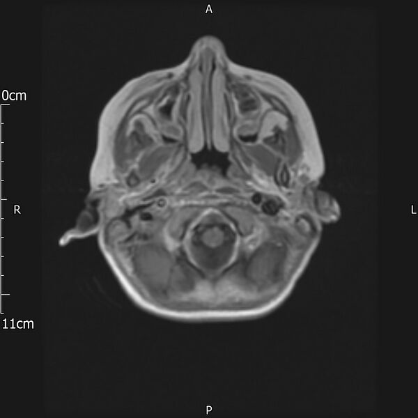 File:Cavernous sinus thrombosis (Radiopaedia 79414-92512 Axial T1 C+ 3).jpg