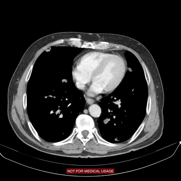 File:Cavitating pulmonary metastases (Radiopaedia 24920-25184 B 19).jpg