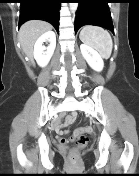 File:Cecum hernia through the foramen of Winslow (Radiopaedia 46634-51112 B 33).png