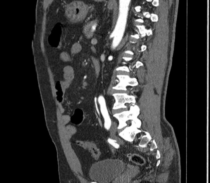 File:Celiac artery dissection (Radiopaedia 52194-58080 B 81).jpg