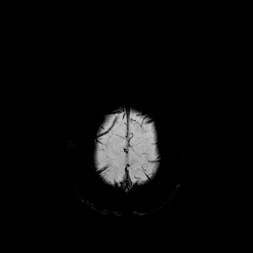 Central neurocytoma (Radiopaedia 79320-92380 Axial SWI 130).jpg