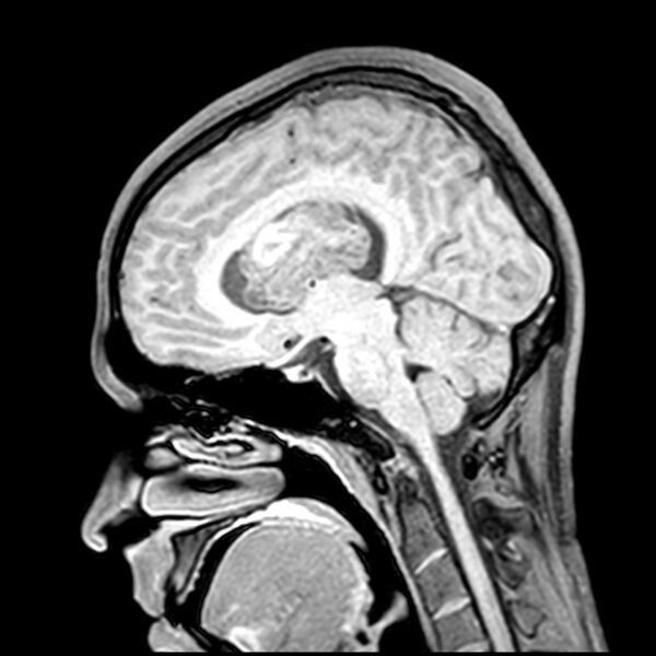 File:Central neurocytoma (Radiopaedia 79320-92380 Sagittal T1 141).jpg