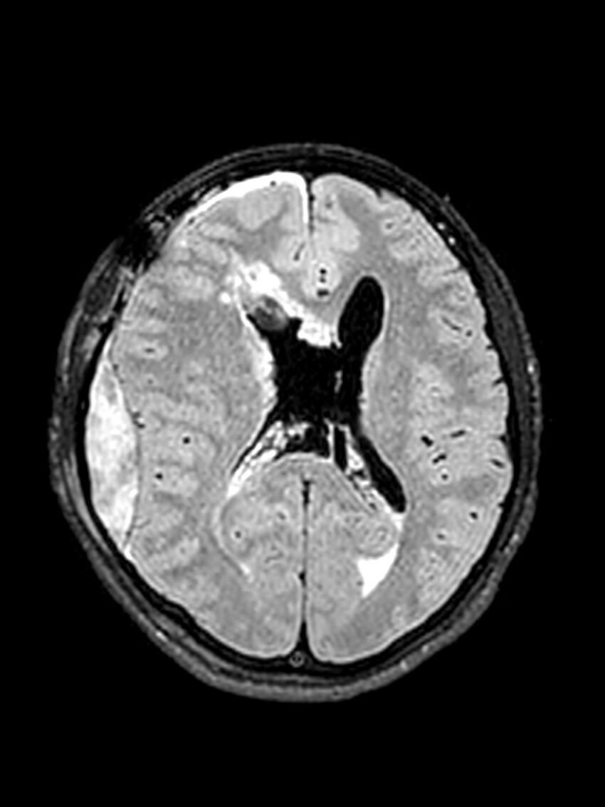 Central neurocytoma (Radiopaedia 79320-92381 Axial FLAIR 77).jpg