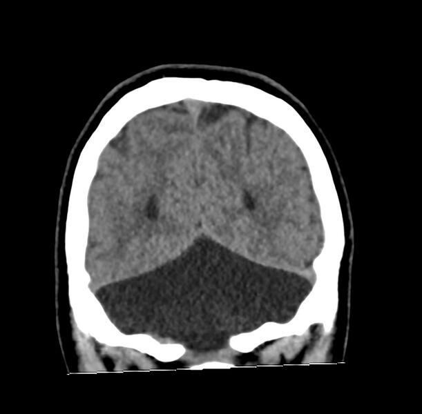 File:Cerebellar agenesis (Radiopaedia 30203-30817 Coronal non-contrast 40).jpg