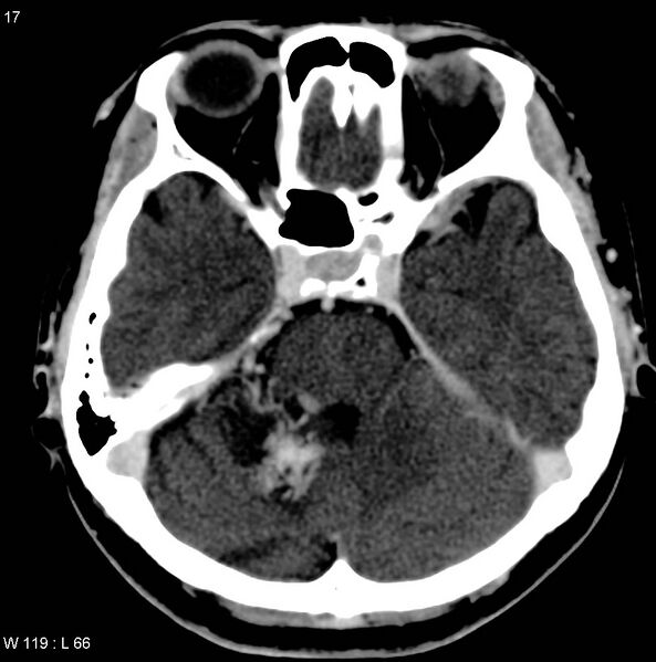 File:Cerebellar arteriovenous malformation (Radiopaedia 5220-36607 A 5).jpg