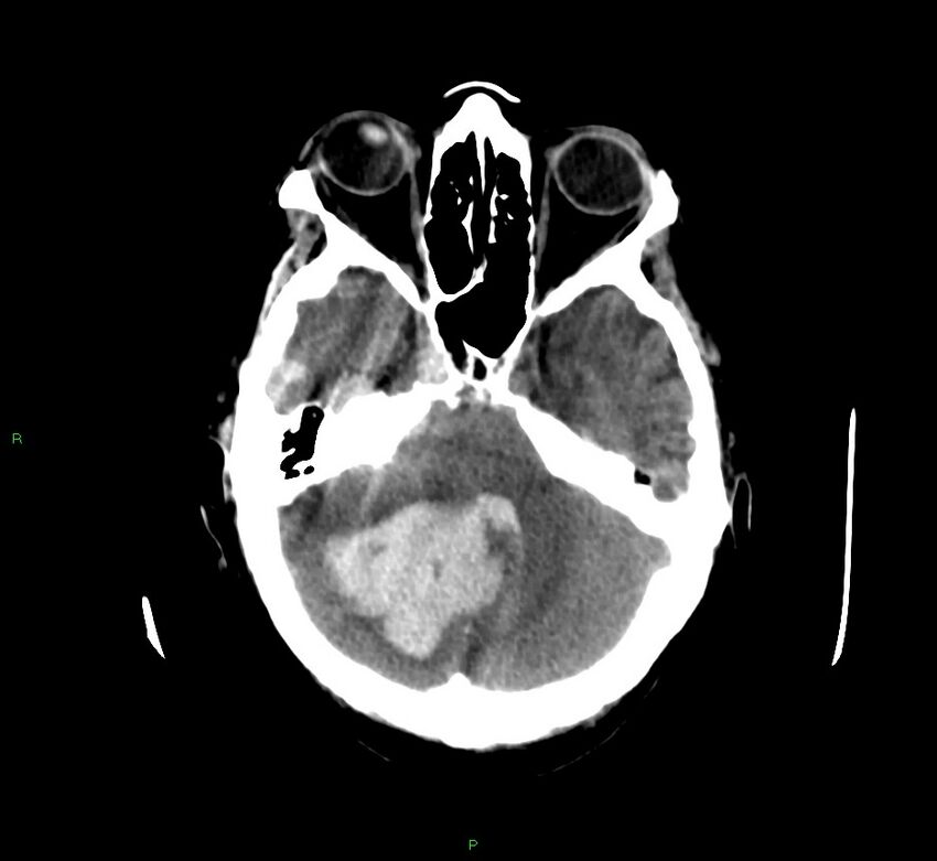 Cerebellar hemorrhage (Radiopaedia 58792-66026 Axial non-contrast 37).jpg