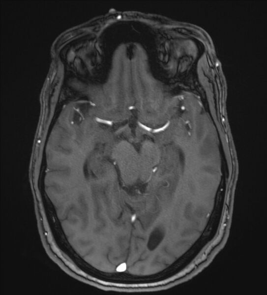 File:Cerebellopontine angle meningioma (Radiopaedia 72983-83680 Axial MRA 52).jpg
