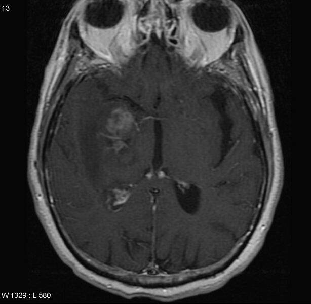 File:Cerebral abscess and ventriculitis (Radiopaedia 5024-6885 Axial T1 C+ 4).jpg