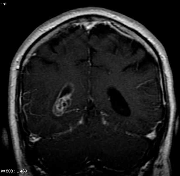 File:Cerebral abscess and ventriculitis (Radiopaedia 5024-6885 Coronal T1 C+ 9).jpg