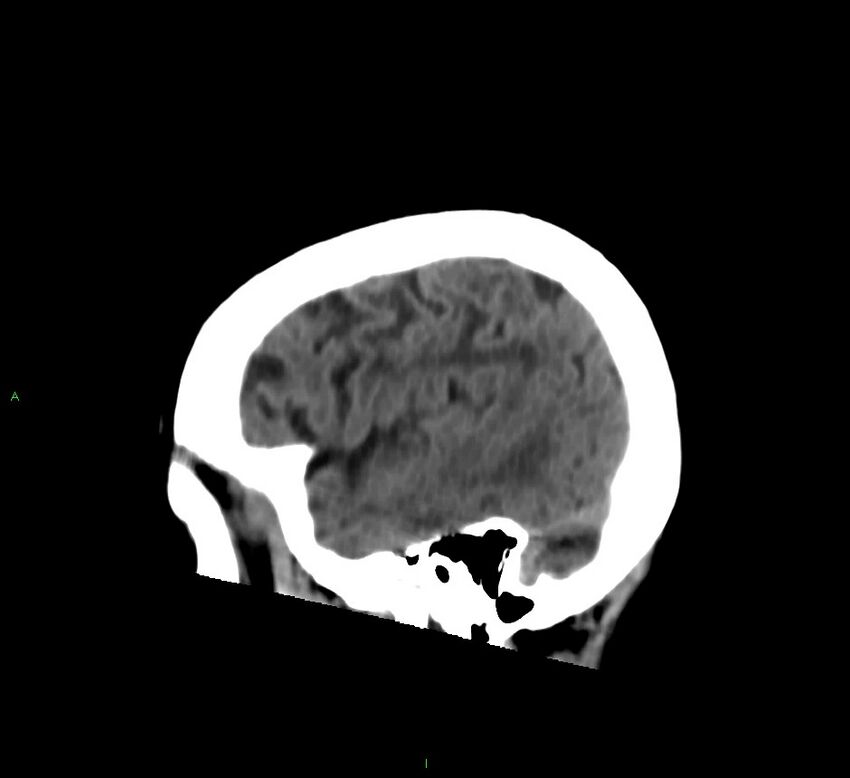 Cerebral amyloid angiopathy-associated lobar intracerebral hemorrhage (Radiopaedia 58376-65513 C 54).jpg