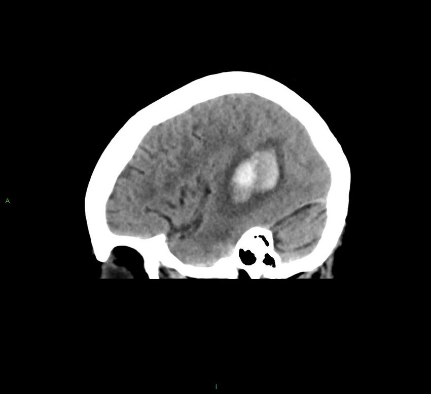 Cerebral amyloid angiopathy-associated lobar intracerebral hemorrhage (Radiopaedia 58378-65516 C 13).jpg