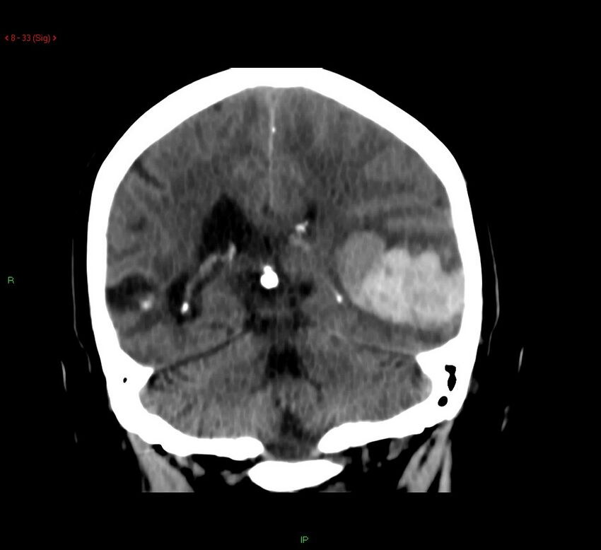 Cerebral amyloid angiopathy-associated lobar intracerebral hemorrhage (Radiopaedia 58378-65518 Coronal non-contrast 33).jpg