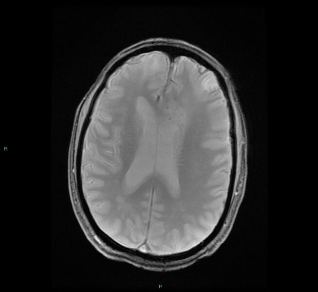 File:Cerebral amyloid angiopathy-associated lobar intracerebral hemorrhage (Radiopaedia 58529-65684 Axial Gradient Echo 16).jpg
