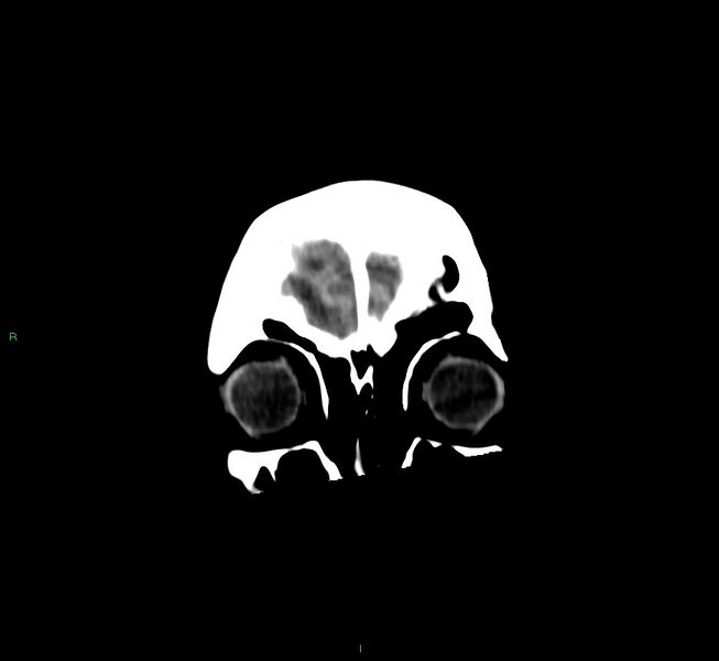 File:Cerebral amyloid angiopathy-associated lobar intracerebral hemorrhage (Radiopaedia 58530-65688 Coronal non-contrast 59).jpg