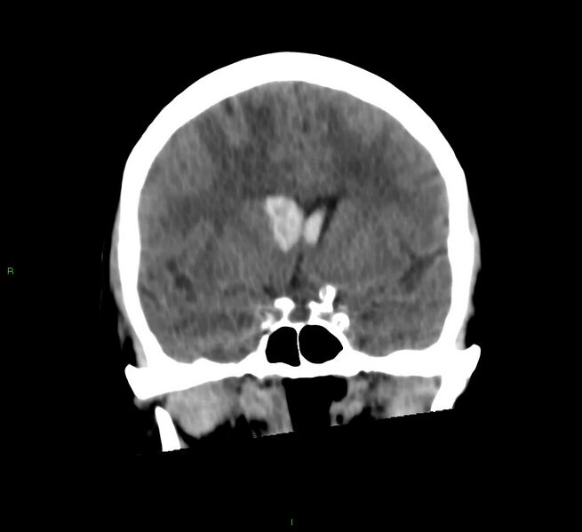 File:Cerebral amyloid angiopathy-associated lobar intracerebral hemorrhage (Radiopaedia 58566-65730 Coronal non-contrast 44).jpg