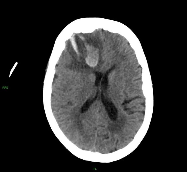 File:Cerebral amyloid angiopathy-associated lobar intracerebral hemorrhage (Radiopaedia 58569-65734 Axial non-contrast 29).jpg