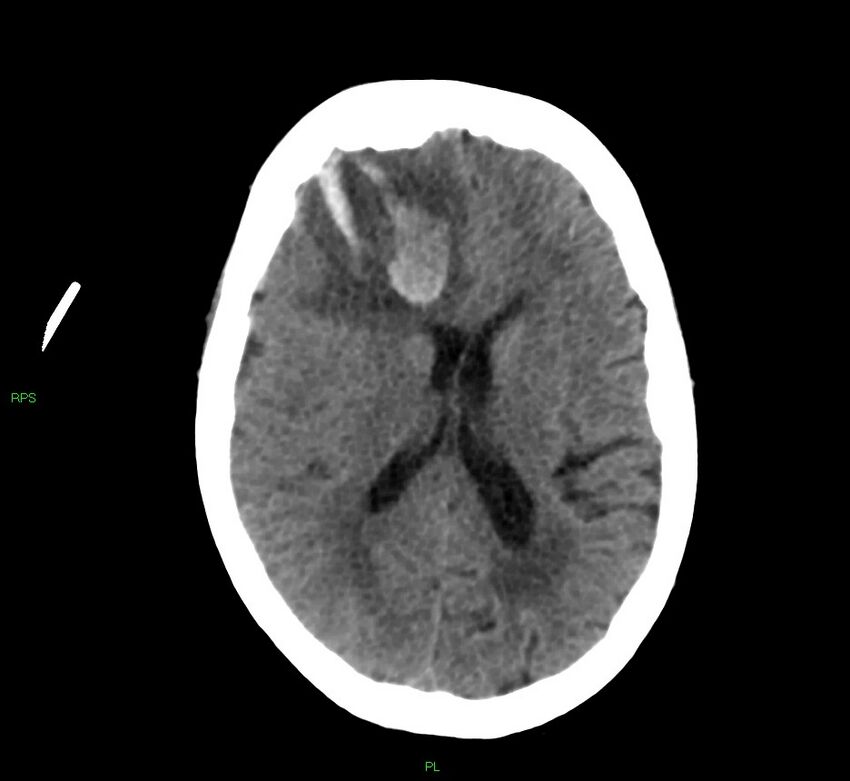 Cerebral amyloid angiopathy-associated lobar intracerebral hemorrhage (Radiopaedia 58569-65734 Axial non-contrast 29).jpg