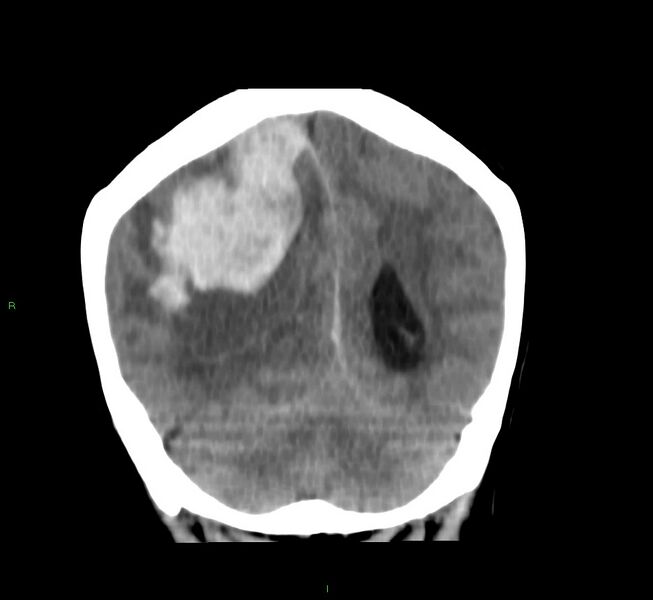 File:Cerebral amyloid angiopathy-associated lobar intracerebral hemorrhage (Radiopaedia 58751-65972 Coronal non-contrast 20).jpg