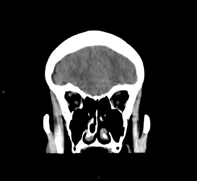 File:Cerebral amyloid angiopathy-associated lobar intracerebral hemorrhage (Radiopaedia 58751-65972 Coronal non-contrast 48).jpg