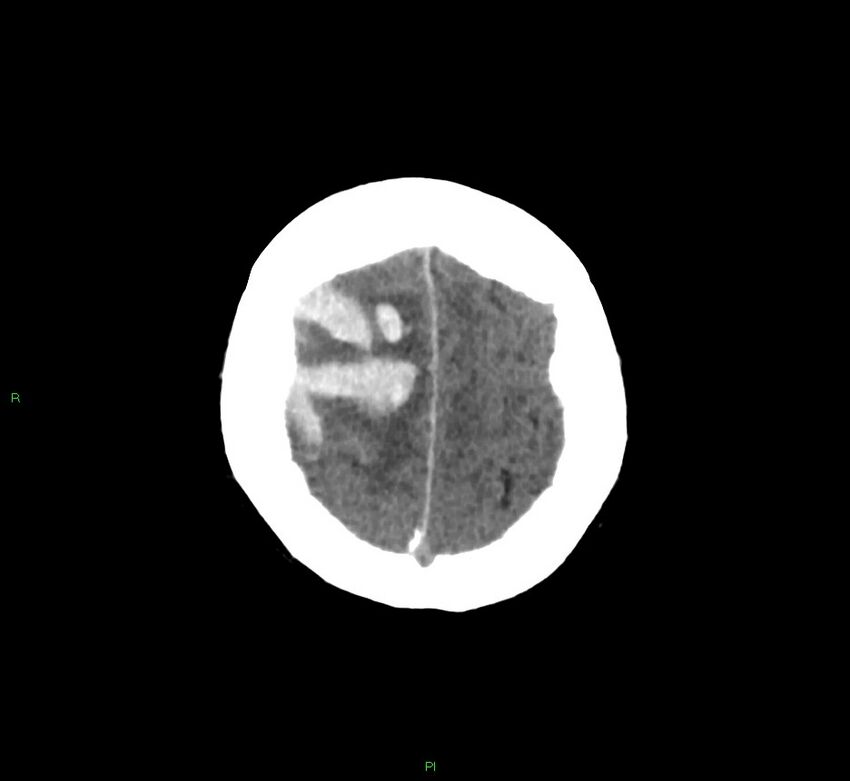 Cerebral amyloid angiopathy-associated lobar intracerebral hemorrhage (Radiopaedia 58756-65977 Axial non-contrast 11).jpg