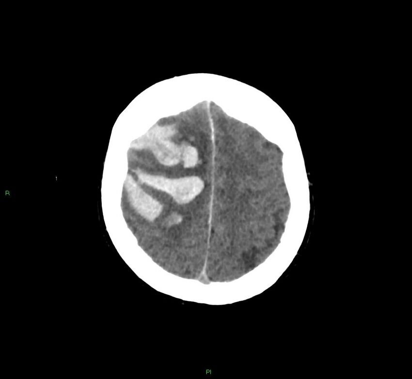 Cerebral amyloid angiopathy-associated lobar intracerebral hemorrhage (Radiopaedia 58756-65977 Axial non-contrast 14).jpg
