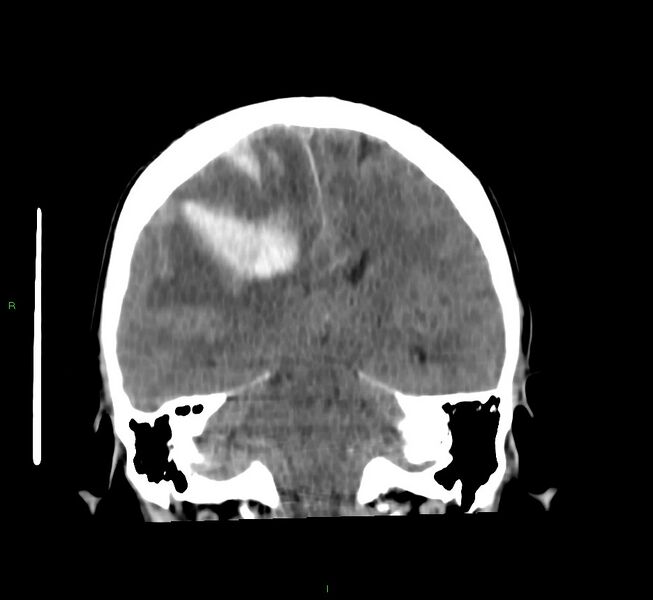 File:Cerebral amyloid angiopathy-associated lobar intracerebral hemorrhage (Radiopaedia 58756-65977 Coronal non-contrast 30).jpg