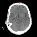 Cerebral and orbital tuberculomas (Radiopaedia 13308-13310 B 12).jpg